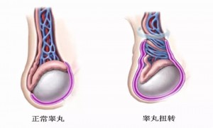 “蛋疼”千万别忍，警惕睾丸扭转