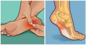 行走的疼痛——足底筋膜炎