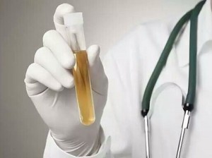  尿常规检验结果中干化学和尿沉渣，该相信谁？