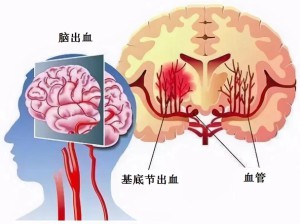 健康知识讲座：高血压性脑出血（ＨＩＣＨ）