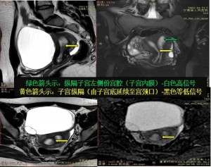 放射科首诊纵隔子宫并卵巢肿瘤蒂扭转