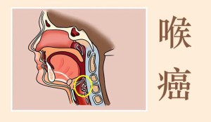 有这两点表现，警惕是喉癌！