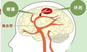 脑梗发生有前兆，知道这些很重要！