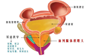 关爱男性健康，了解前列腺增生