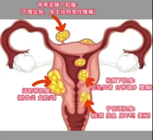 “妇”卫健康，打击子宫肌瘤